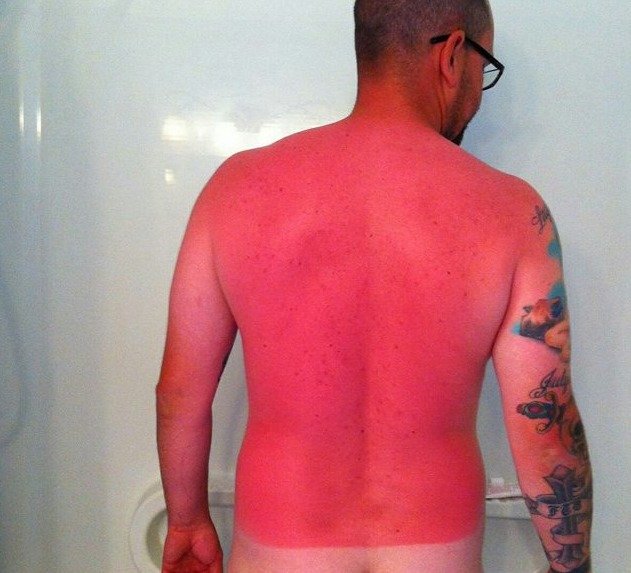 sunburn fail